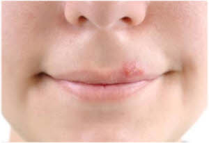 izlečite herpes na usni prirodnim lekom