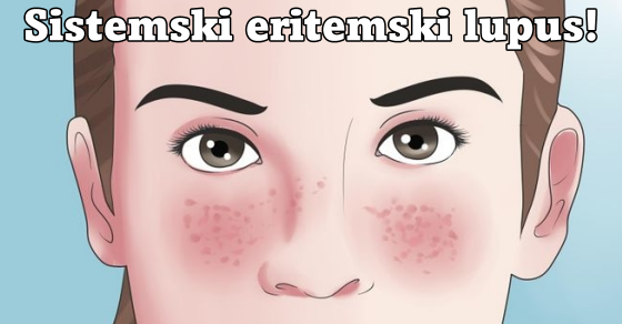 Ta Je Sistemski Lupus Simptomi Le Enje Prognoza