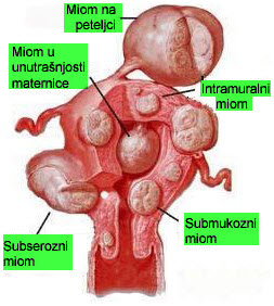 miom na materici kako se leci miom na materici simptomi bolesti
