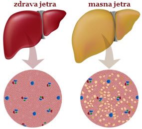kako se leči masna jetra dijetom i ishranom masna jetra prirodno lečenje