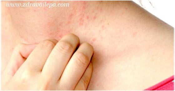 Kožne alergije