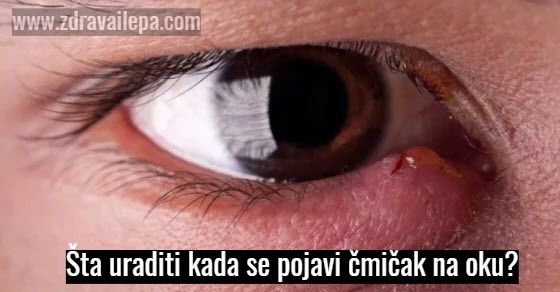 kako izlečiti čmičak na oku cmicak na oku recepti